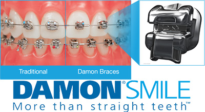 Damon Self-Ligating Braces