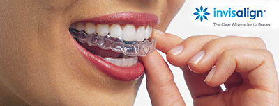 Invisalign clear braces