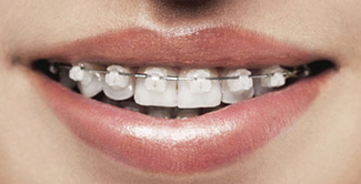 ceramic clear braces