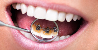 lingual braces