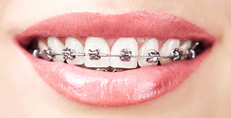 metal braces