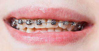 self-ligating braces