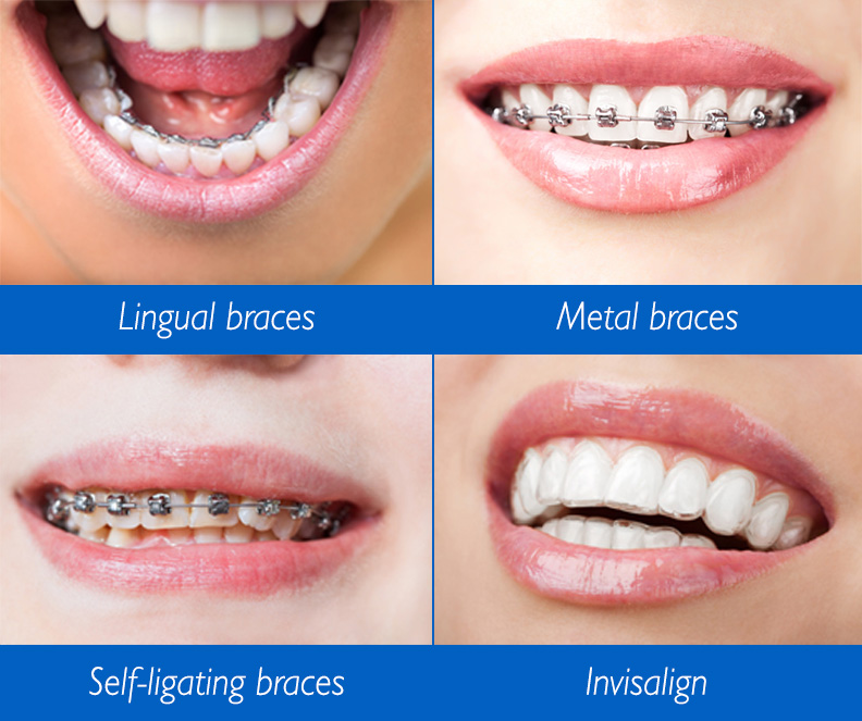 What Advantages Do Lingual Braces Have Over Traditional? - Hardy