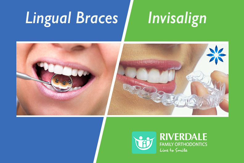 lingual braces vs Invisalign