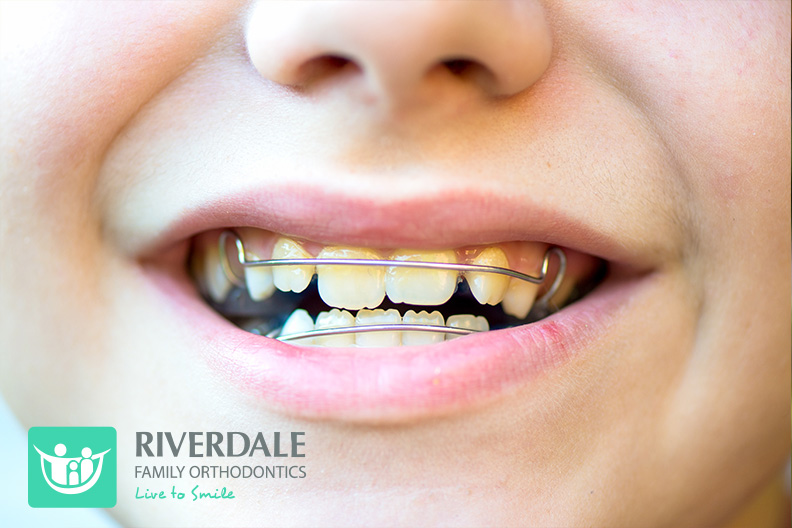 early orthodontic treatment