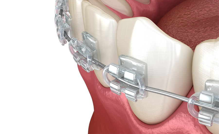 Ceramic clear braces