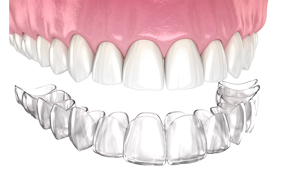 Invisalign clear aligners