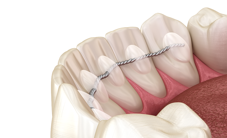 lingual braces