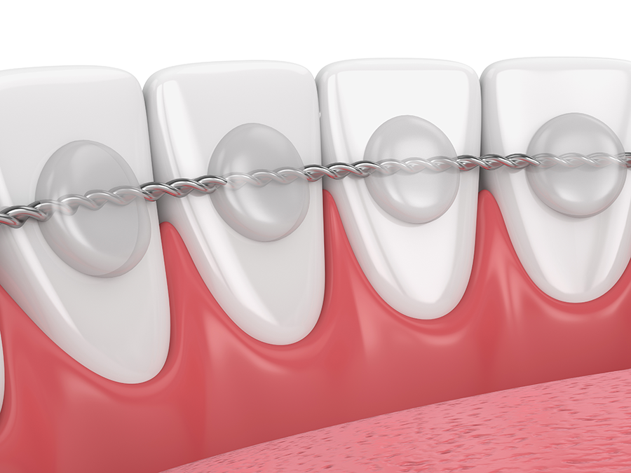 permanent dental retainers