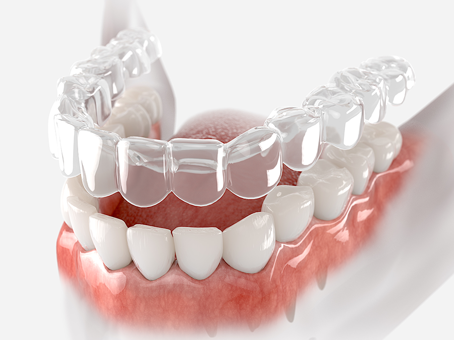 removable clear braces