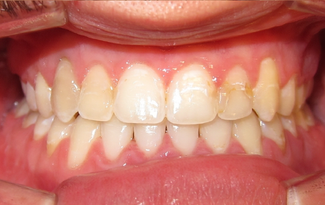 After image