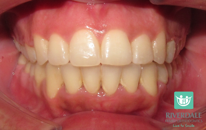 After image