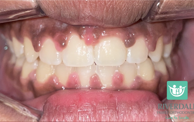 After image