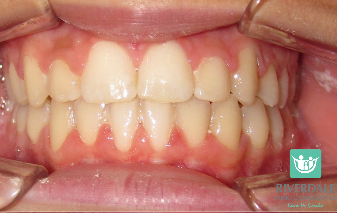 After image