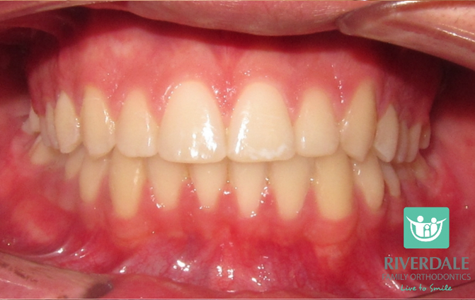 After image
