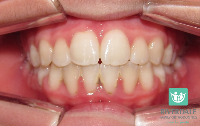 After image