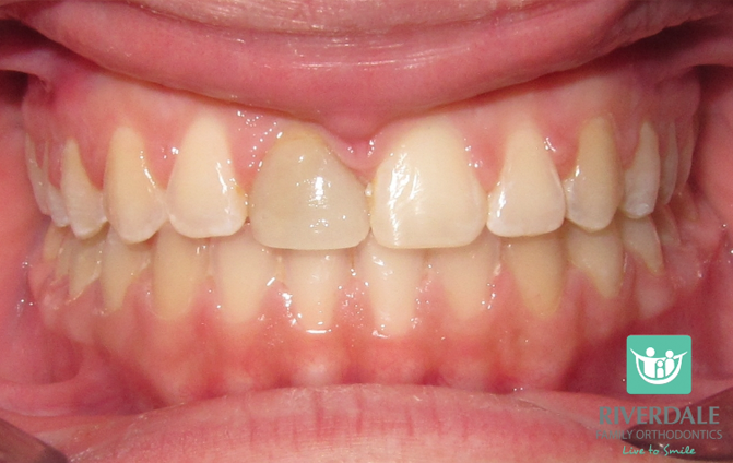 After image