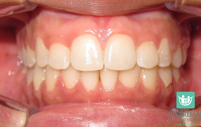After image