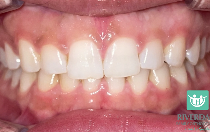 After image