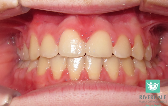 After image