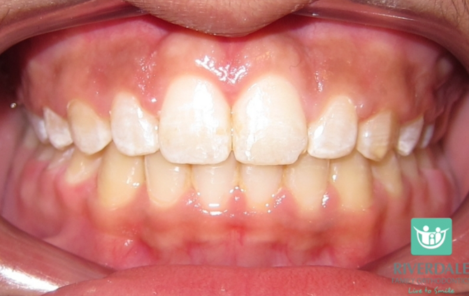 After image
