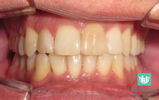 After image