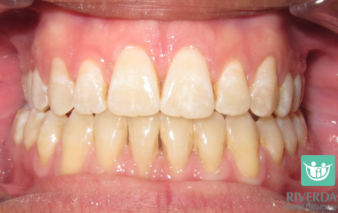 After image