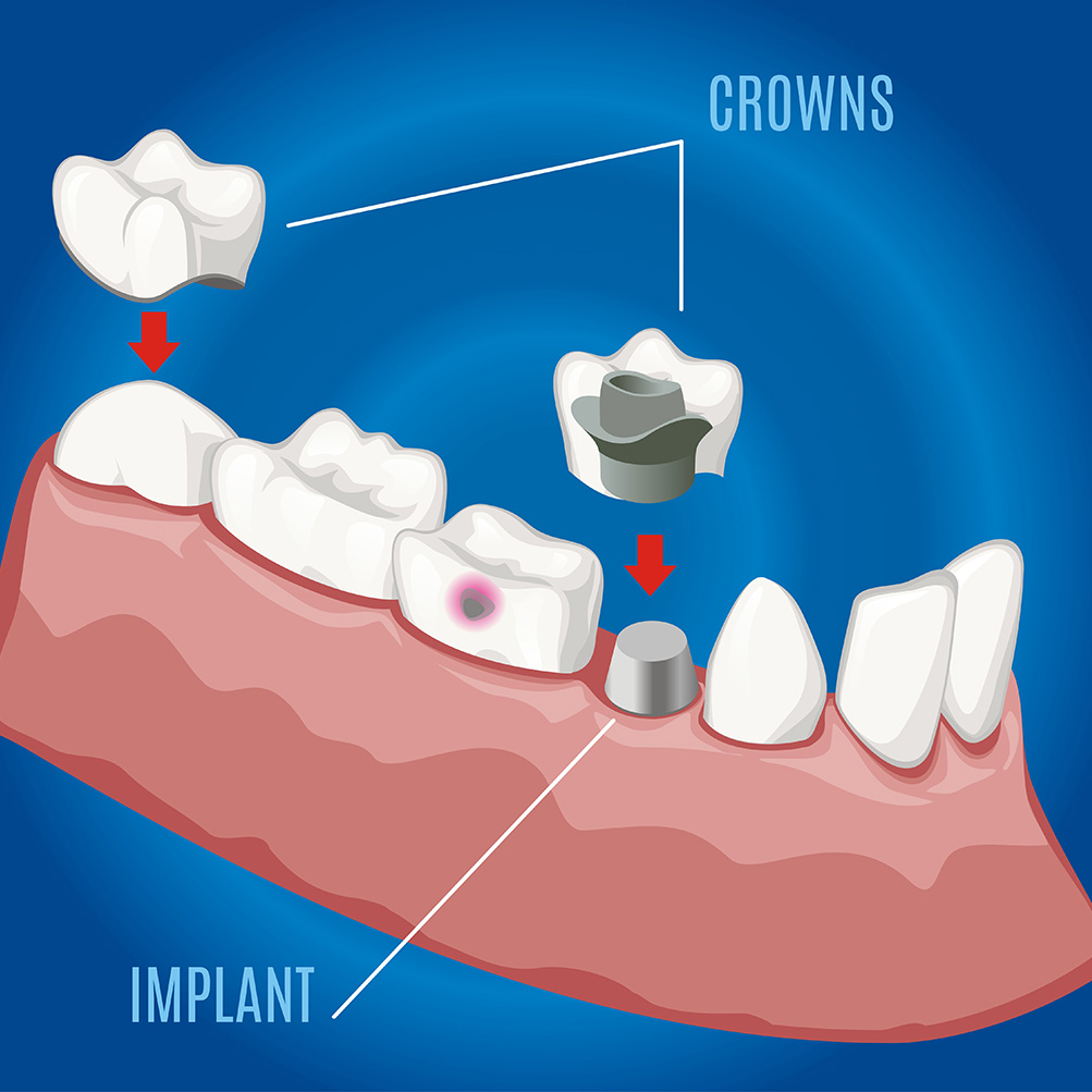 Invisalign and dental crown