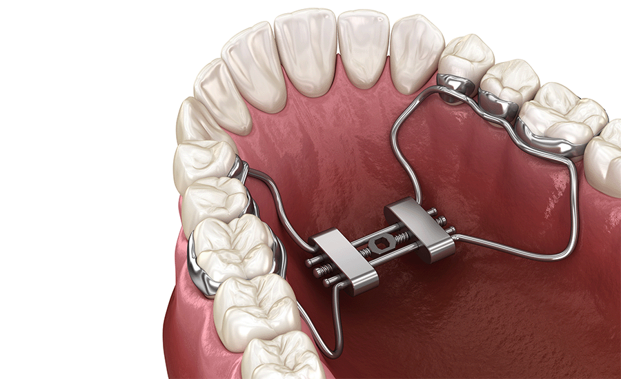 Palatal Expander