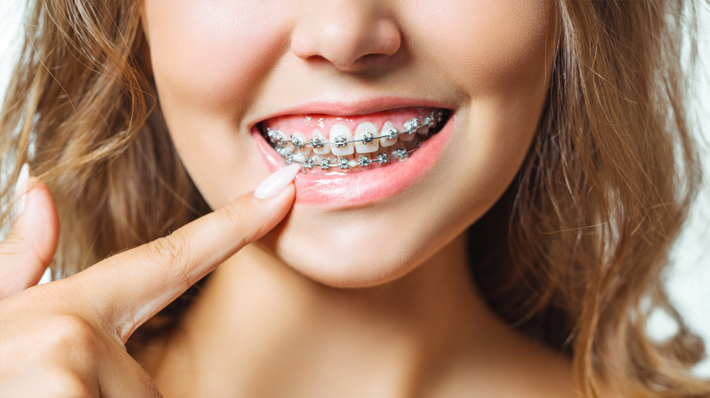 How Long Does It Take for Braces to Work